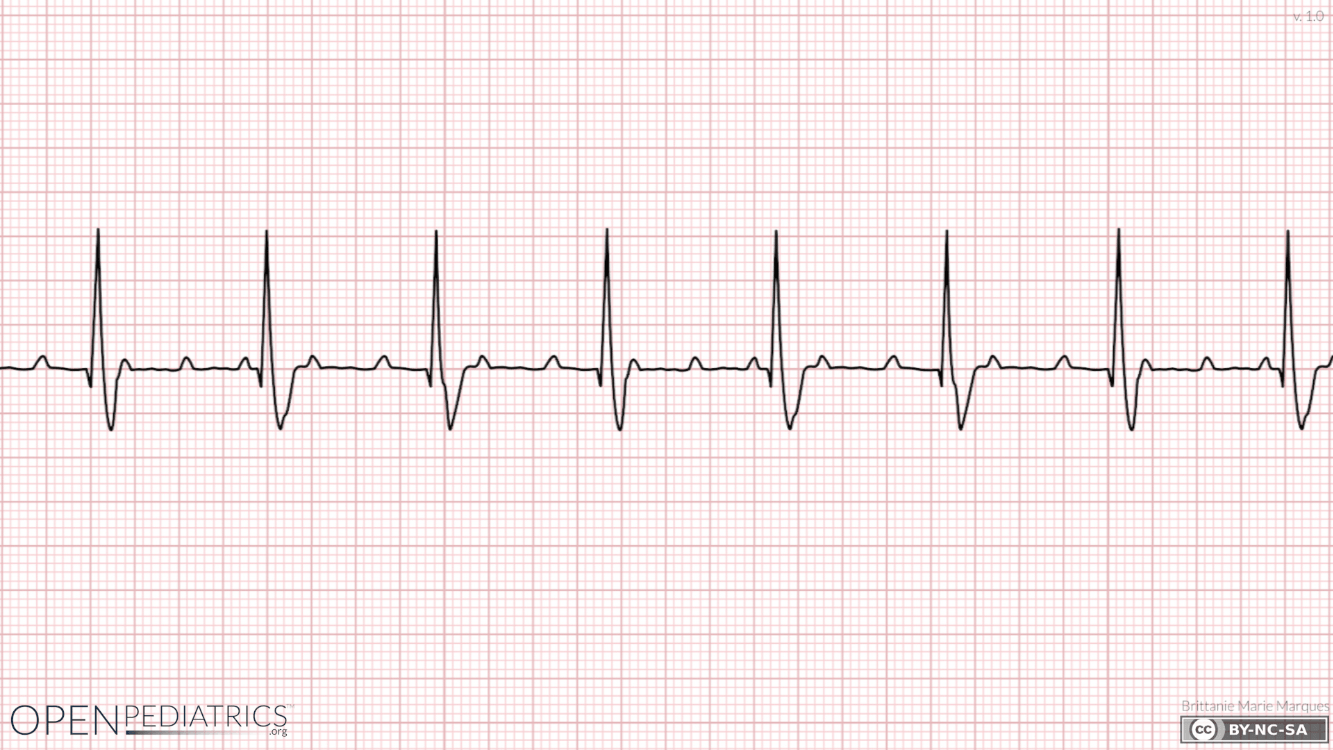 Basic ECG Jeopardy! Jeopardy Template