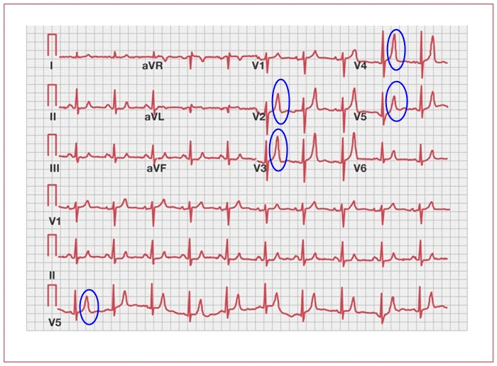 Гиперкалиемия на экг картинки