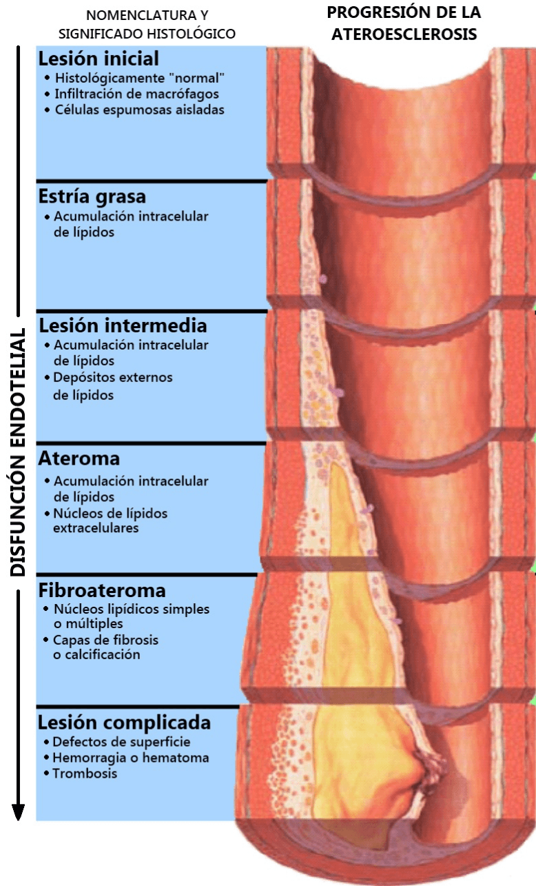 Атеросклероз патогенез патфиз. Клинико-морфологические формы атеросклероза. Морфологические изменения атеросклероз. Морфологические изменения атеросклероз. Атеросклероз долипидная стадии патанатомия.