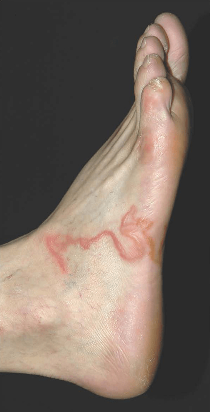 cutaneous-larva-migrans