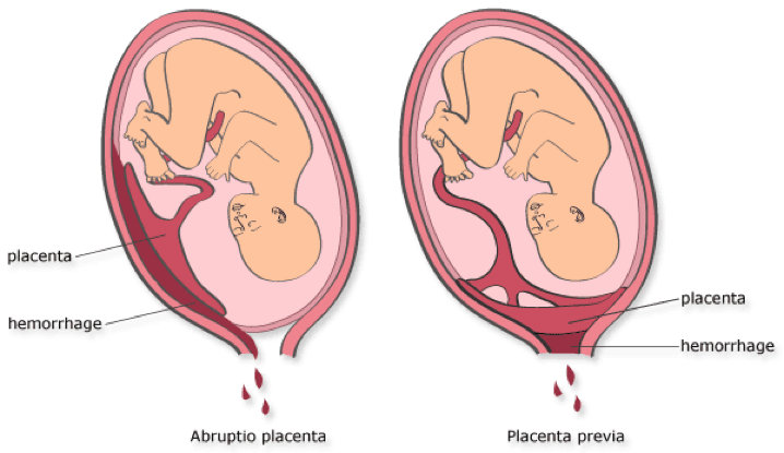 descolamento prematuro da placenta sintomas de diabetes