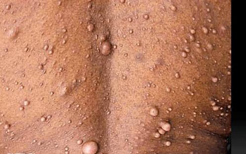 Peds Neuro Jeopardy - March Jeopardy Template