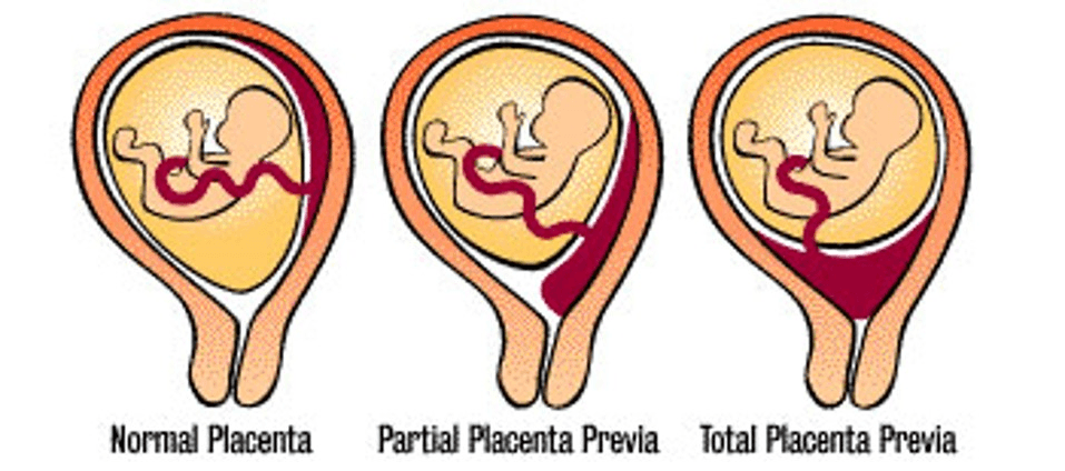 pelvic rest for low lying placenta