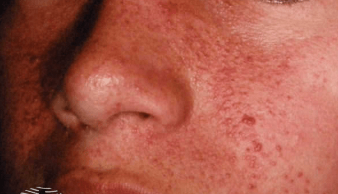 Acne for the PCP