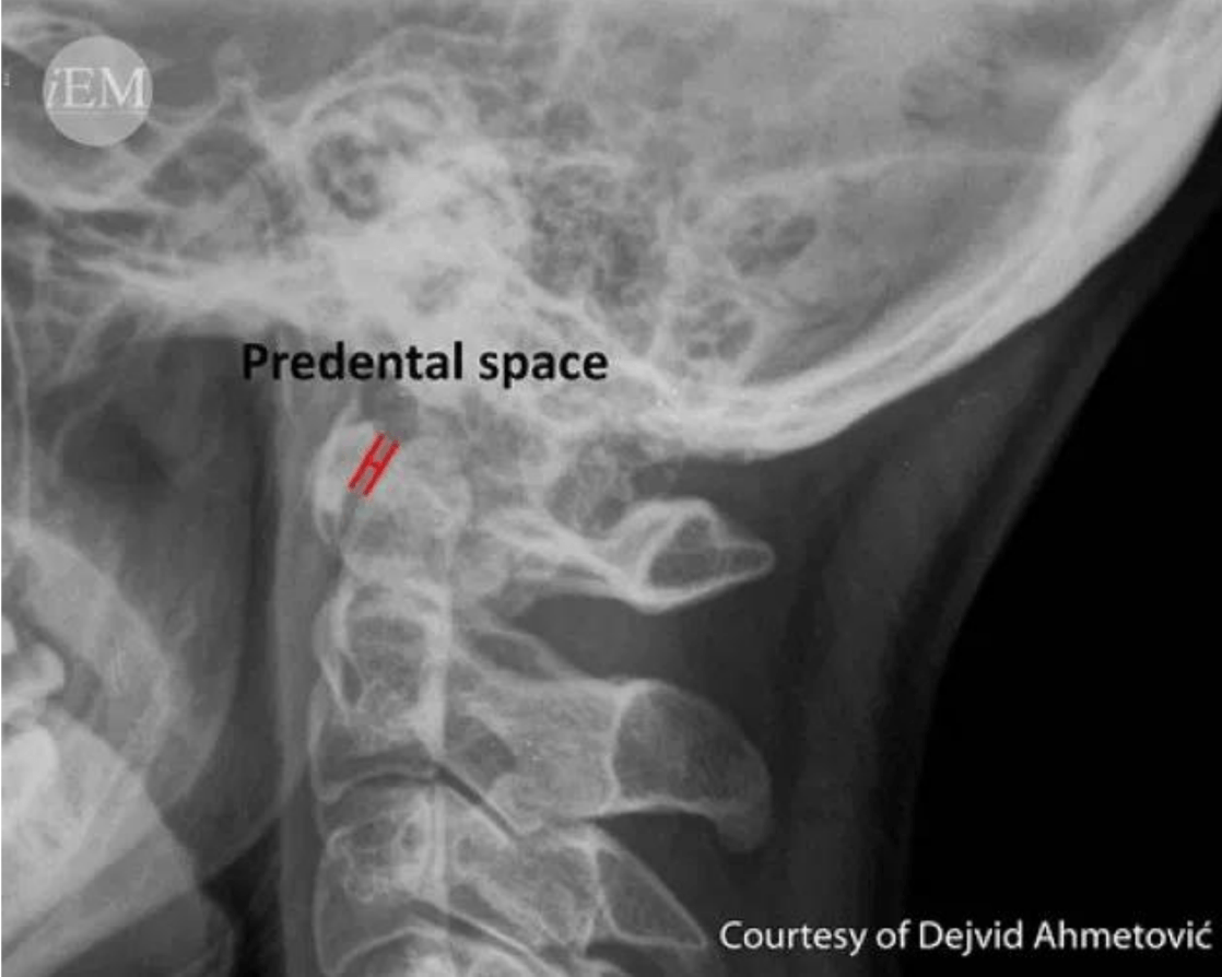 Radiology CSpine & T spine Jeopardy Template