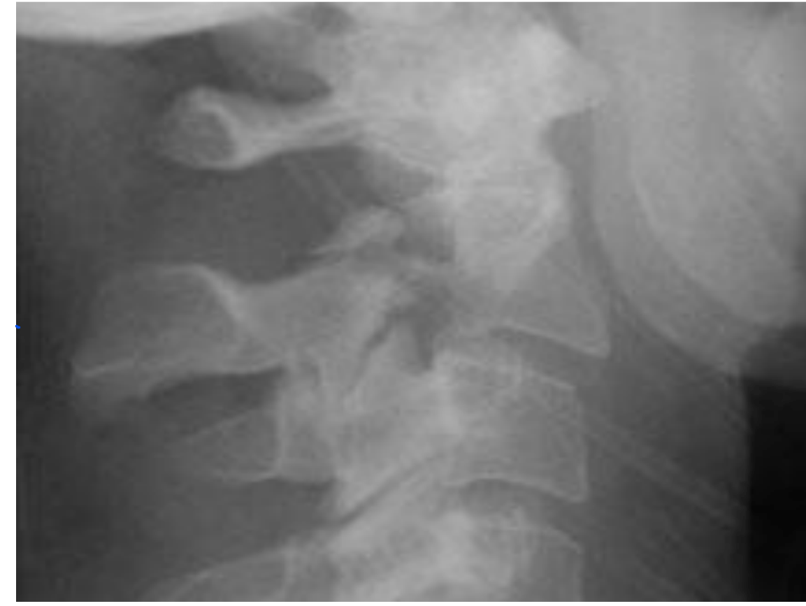 Radiology CSpine & T spine Jeopardy Template