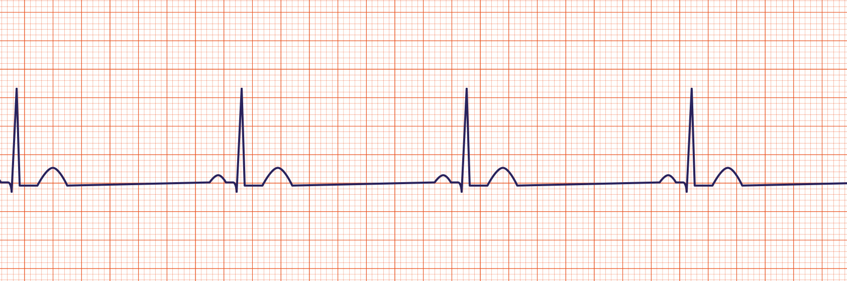 Тахикардия и брадикардия. Синус брадикардия. Sinus bradycardia ECG. Sinus tachycardia ECG. Брадикардия на мониторе.