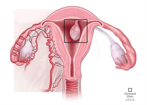 Sonohysterography And Polyps