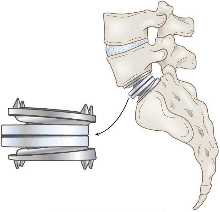 Musculoskeletal disorders (Intervertebral Disc Disease) Jeopardy Template